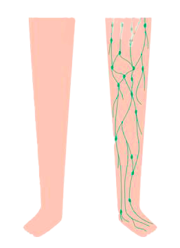 Lymphedema Stage One