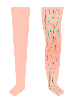 Lymphedema Stage Two