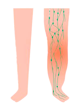 Lymphedema Stage Three