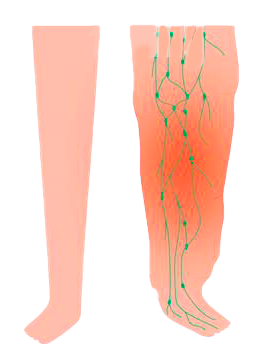 Lymphedema Stage Four